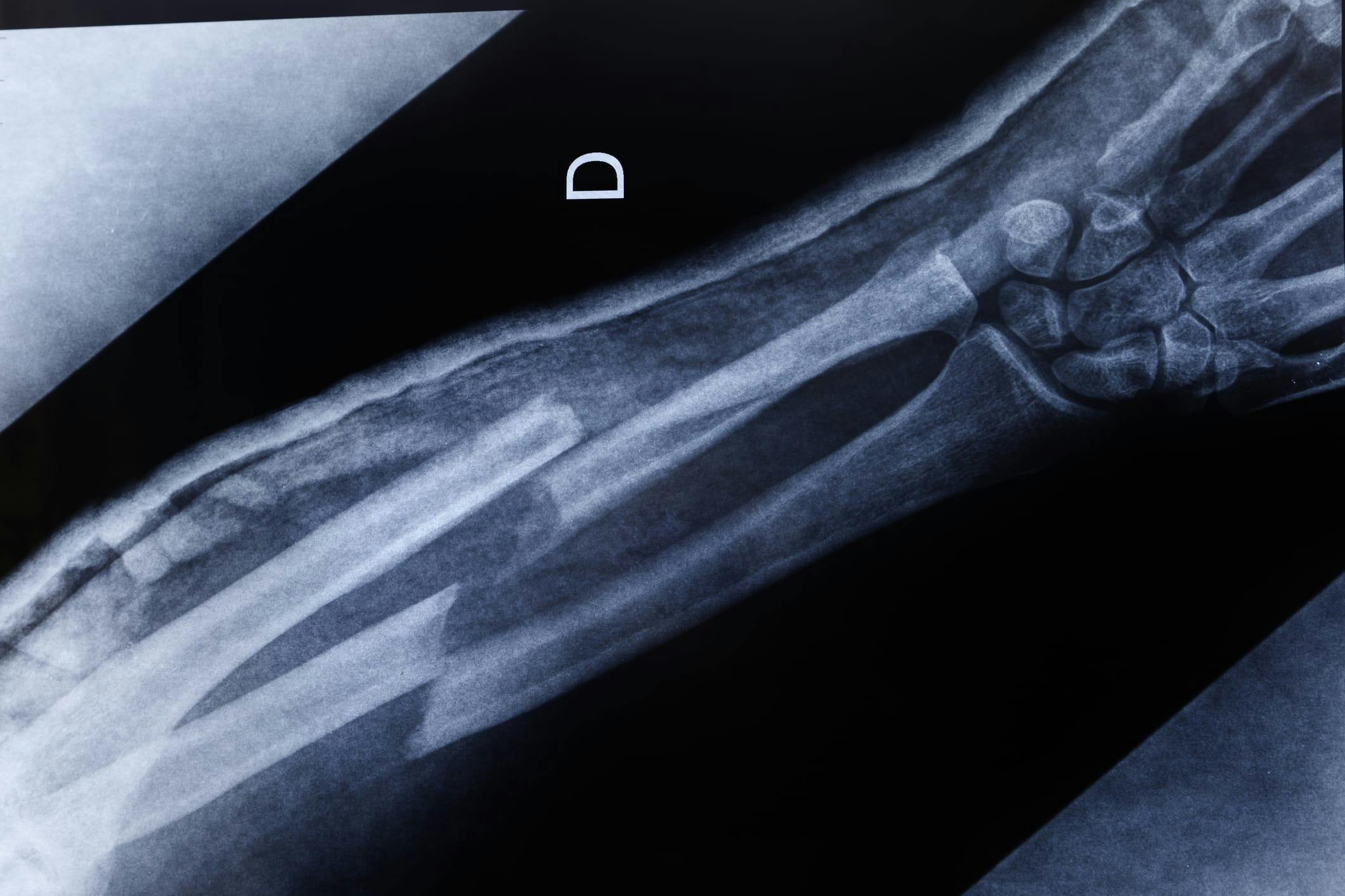 x-ray of a broken arm