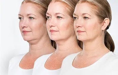 KYBELLA Before & After Gallery - Patient 168495247 - Image 1