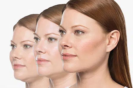 KYBELLA Before & After Gallery - Patient 174894582 - Image 1