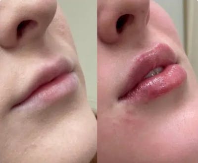Lip Fillers Before & After Gallery - Patient 174893722 - Image 1