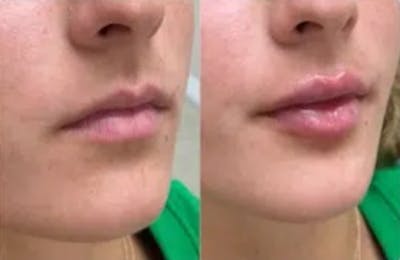 Lip Fillers Before & After Gallery - Patient 168495736 - Image 1