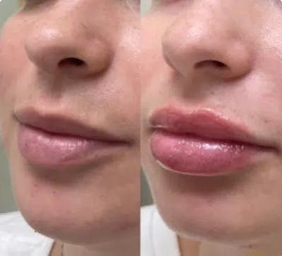 Lip Fillers Before & After Gallery - Patient 174893721 - Image 1