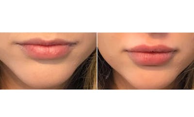 Lip Fillers Before & After Gallery - Patient 174893720 - Image 1