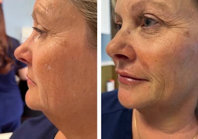 Cheek Contour Before & After Gallery - Patient 168496241 - Image 1