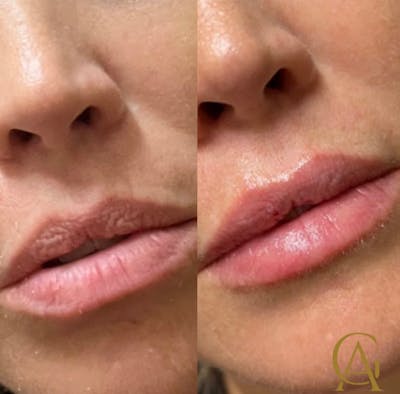 Lip Fillers Before & After Gallery - Patient 176816246 - Image 1