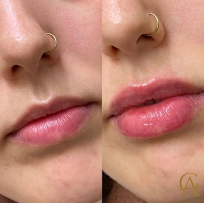 Lip Fillers Before & After Gallery - Patient 176816247 - Image 1