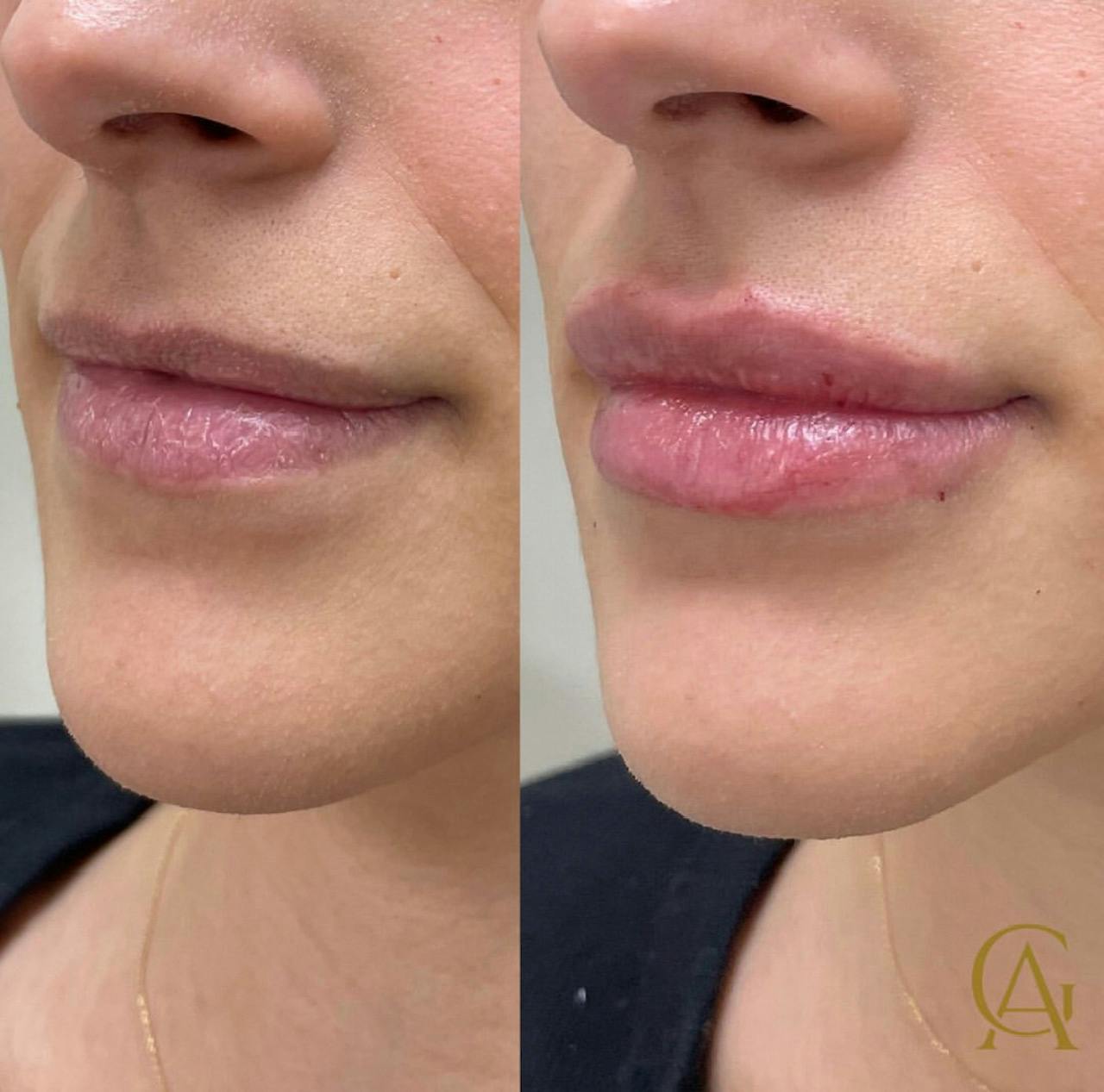 Lip Fillers Before & After Gallery - Patient 176816248 - Image 1