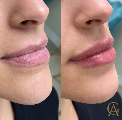 Lip Fillers Before & After Gallery - Patient 176816249 - Image 1