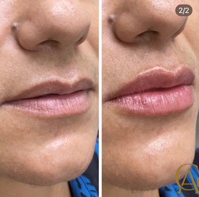 Lip Fillers Before & After Gallery - Patient 176816250 - Image 1