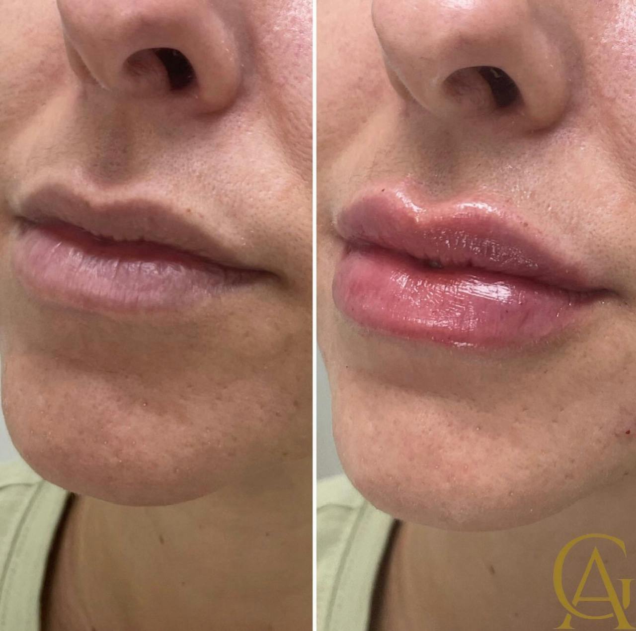 Lip Fillers Before & After Gallery - Patient 176816252 - Image 1