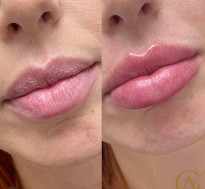 Lip Fillers Before & After Gallery - Patient 176816251 - Image 1