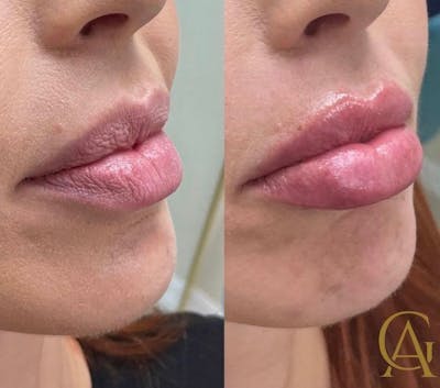 Lip Fillers Before & After Gallery - Patient 176816253 - Image 1