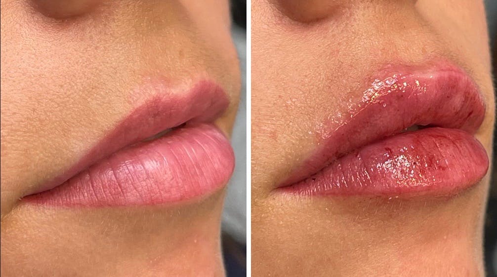 Lip Fillers Before & After Gallery - Patient 176816254 - Image 1