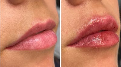 Lip Fillers Before & After Gallery - Patient 176816254 - Image 1