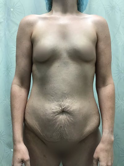 Tummy Tuck Before & After Gallery - Patient 175151533 - Image 1