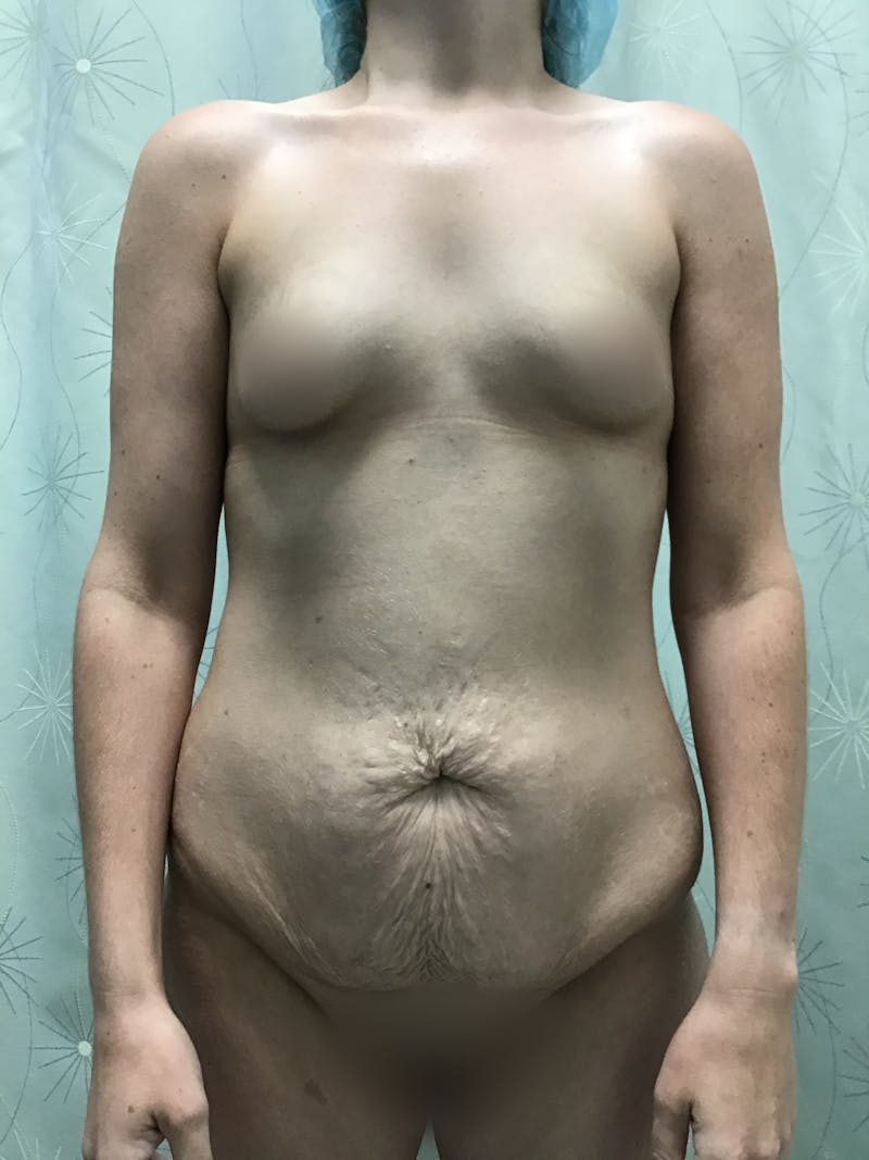 Tummy Tuck Before & After Gallery - Patient 175151533 - Image 1