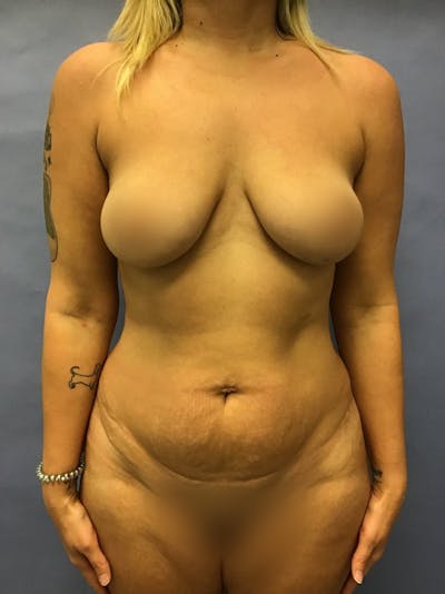 Tummy Tuck Before & After Gallery - Patient 175151697 - Image 1