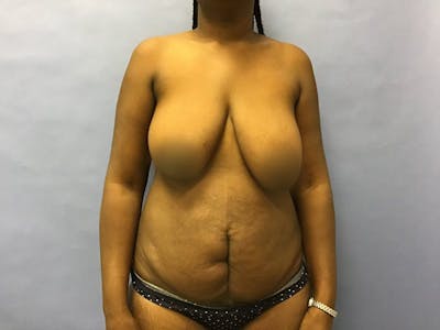 Tummy Tuck Before & After Gallery - Patient 175151756 - Image 1