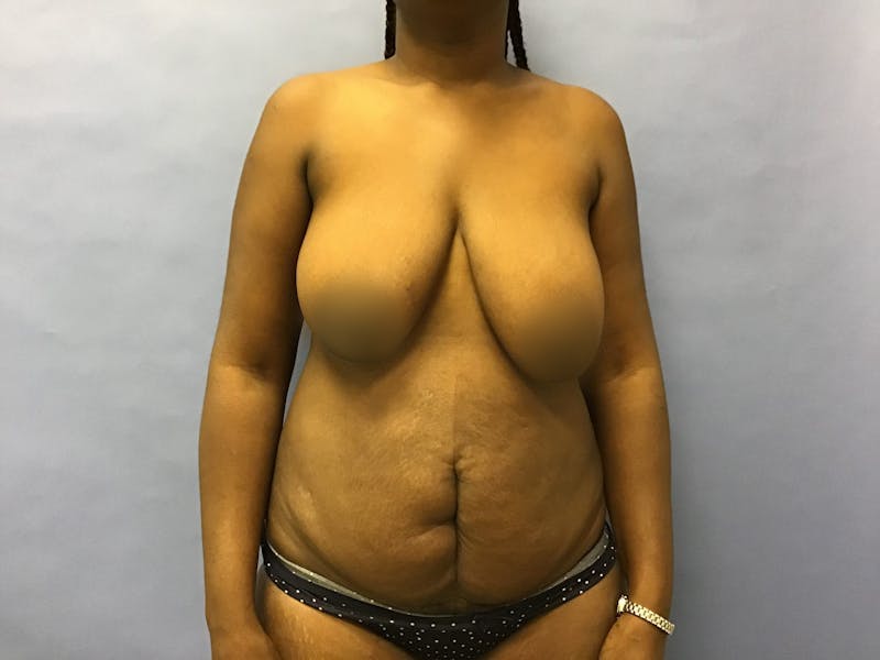 Tummy Tuck Before & After Gallery - Patient 175151756 - Image 1