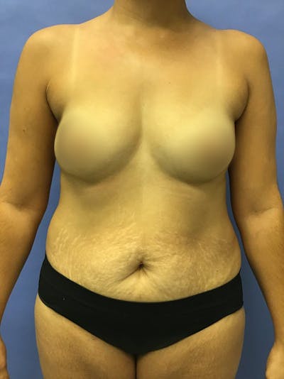 Liposuction Before & After Gallery - Patient 175151944 - Image 1
