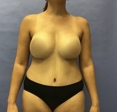 Liposuction Before & After Gallery - Patient 175151944 - Image 2
