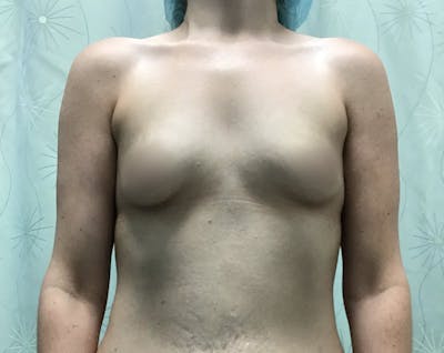Breast Augmentation Before & After Gallery - Patient 175151911 - Image 1