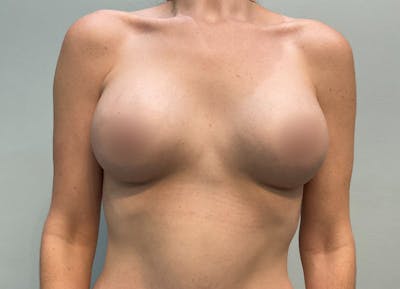 Breast Augmentation Before & After Gallery - Patient 175151911 - Image 2
