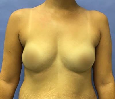 Breast Augmentation Before & After Gallery - Patient 175151919 - Image 1