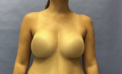 Breast Augmentation Before & After Gallery - Patient 175151919 - Image 2