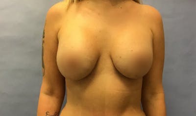 Breast Lift Before & After Gallery - Patient 175174054 - Image 2