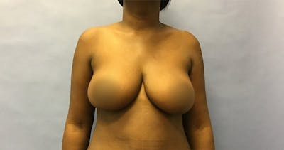 Breast Lift Before & After Gallery - Patient 175175418 - Image 2