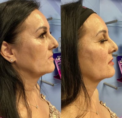 Lip Fillers Before & After Gallery - Patient 176839008 - Image 1