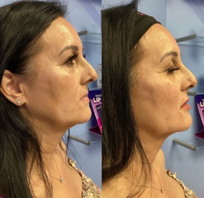 Liquid (Non-Surgical) Facelift Before & After Gallery - Patient 177150321 - Image 1