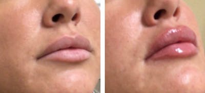 Lip Fillers Before & After Gallery - Patient 177147587 - Image 1