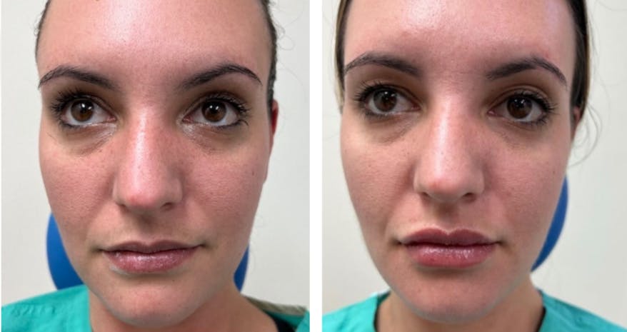 Lip Fillers Before & After Gallery - Patient 177147941 - Image 1