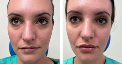 Lip Fillers Before & After Gallery - Patient 177147941 - Image 1