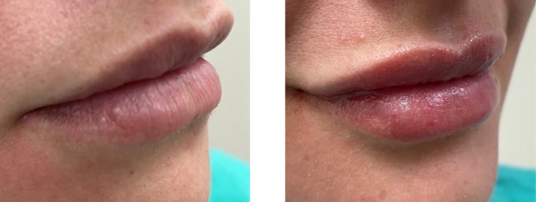 Lip Fillers Before & After Gallery - Patient 177147953 - Image 1