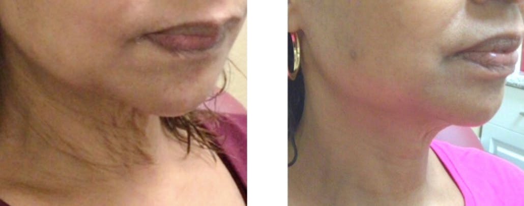 BOTOX Before & After Gallery - Patient 177147963 - Image 1