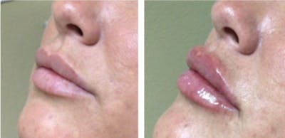 Lip Fillers Before & After Gallery - Patient 177147986 - Image 1