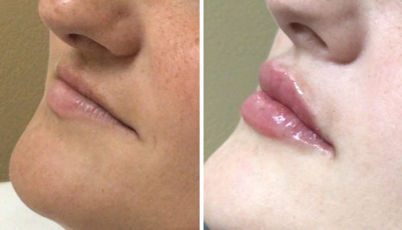 Lip Fillers Before & After Gallery - Patient 177148000 - Image 1