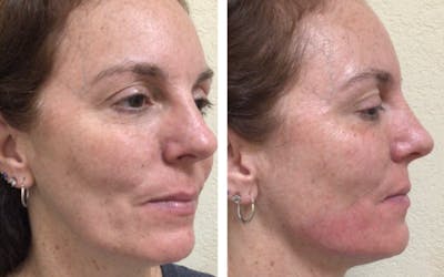 Liquid Chin & Jaw Contouring Before & After Gallery - Patient 177148016 - Image 1