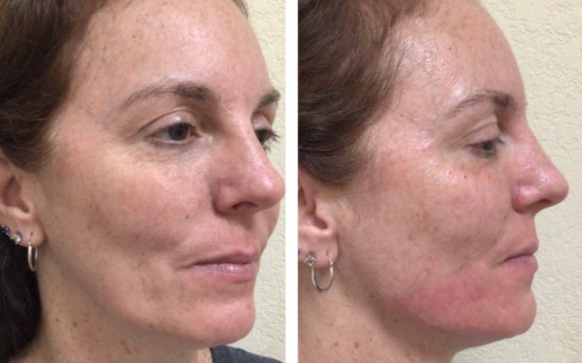 Liquid Chin & Jaw Contouring Before & After Gallery - Patient 177148016 - Image 1