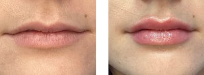Lip Fillers Before & After Gallery - Patient 177149566 - Image 1