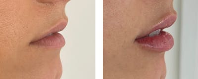 Lip Fillers Before & After Gallery - Patient 177149688 - Image 1