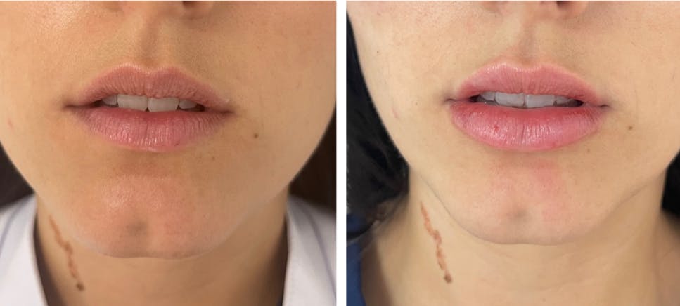 Lip Fillers Before & After Gallery - Patient 177149689 - Image 1