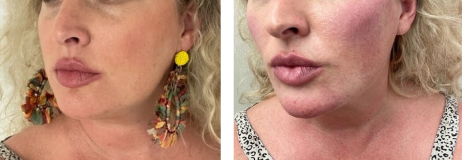 Liquid Chin & Jaw Contouring Before & After Gallery - Patient 177149736 - Image 1