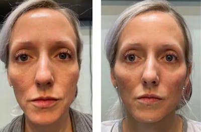 Liquid (Non-Surgical) Facelift Before & After Gallery - Patient 177150332 - Image 1