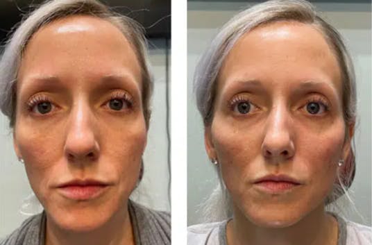 Liquid (Non-Surgical) Facelift Before & After Gallery - Patient 177150332 - Image 1