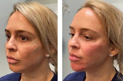 Liquid (Non-Surgical) Facelift Before & After Gallery - Patient 177150337 - Image 1