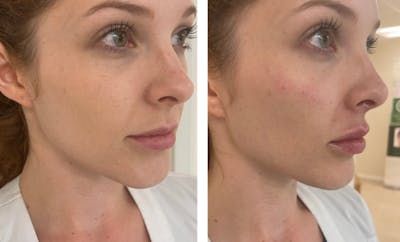 Cheek Contour Before & After Gallery - Patient 177166871 - Image 1